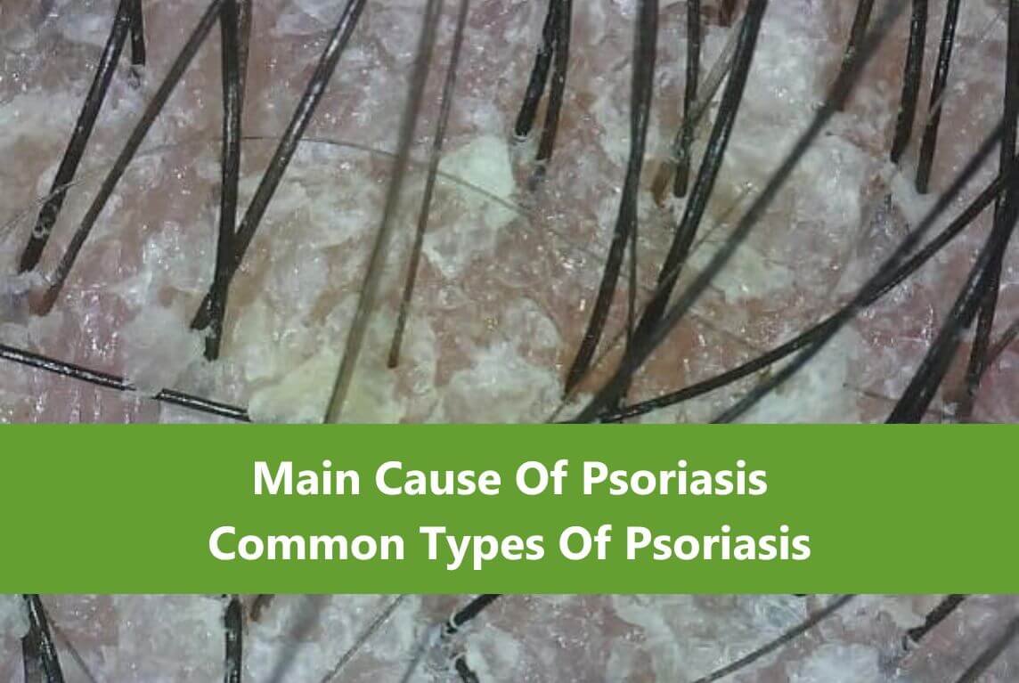 AROMASE Common Types Of Psoriasis