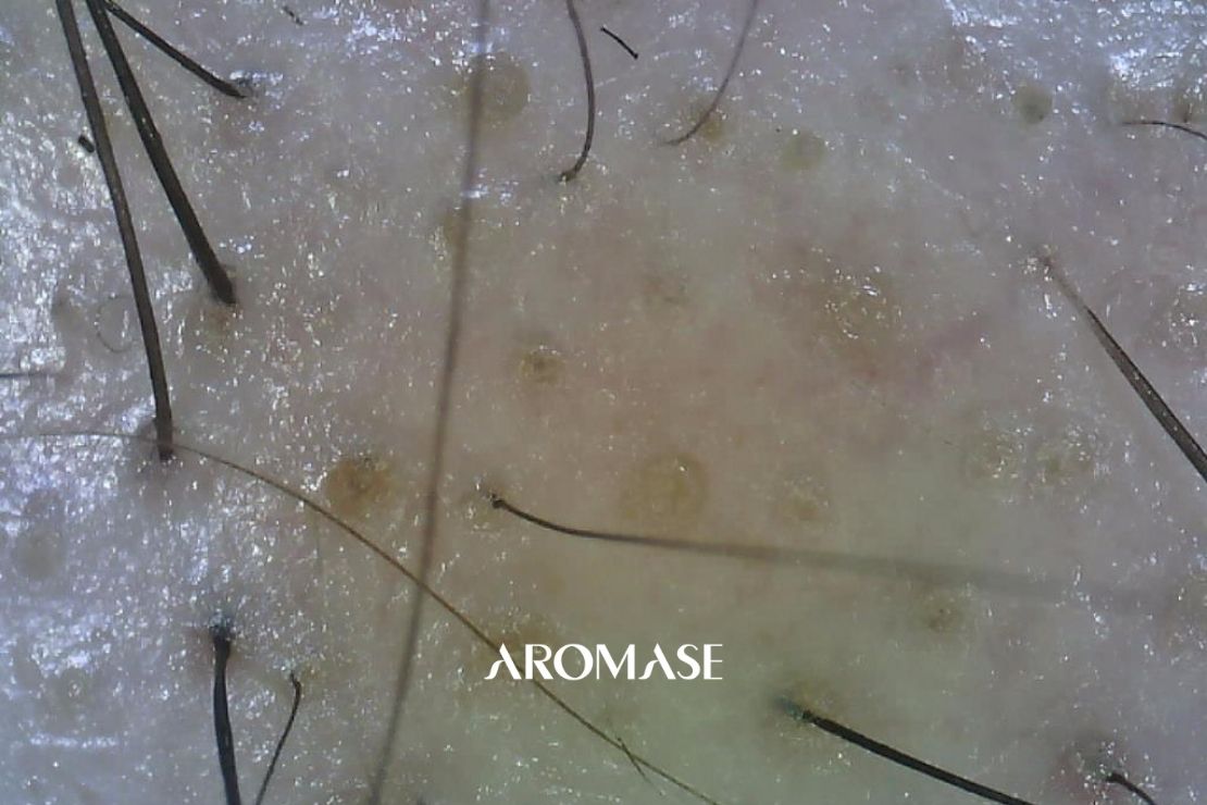 AROMASE-Bald spots-Alopecia Areata-1