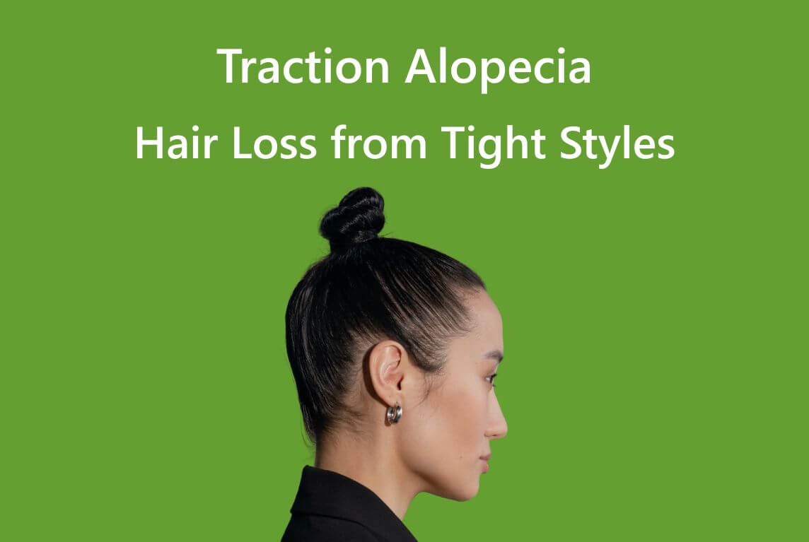 AROMASE-Hair Loss from Tight Styles-Traction Alopecia Cause Prevent and Reduce 2