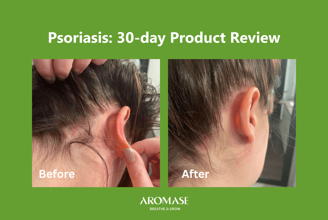 Scalp psoriasis treatment 30days review AROMASE