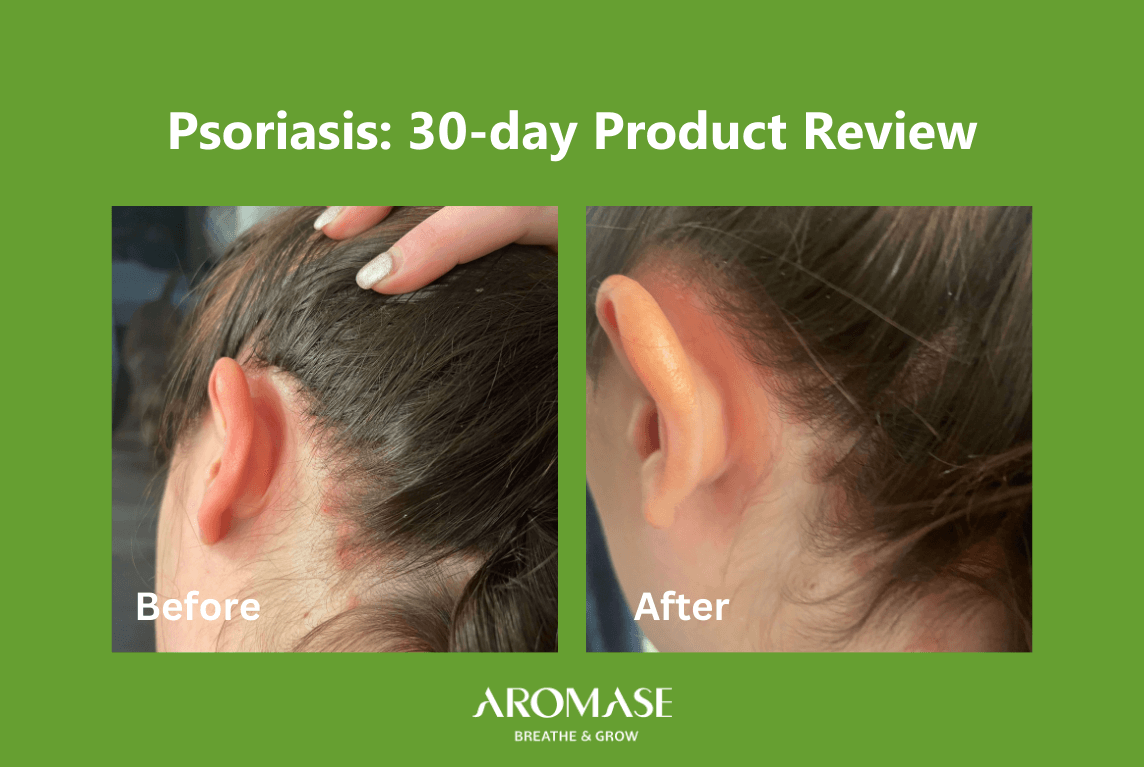 AROMASE psoriasis scalp test_Lane (2)