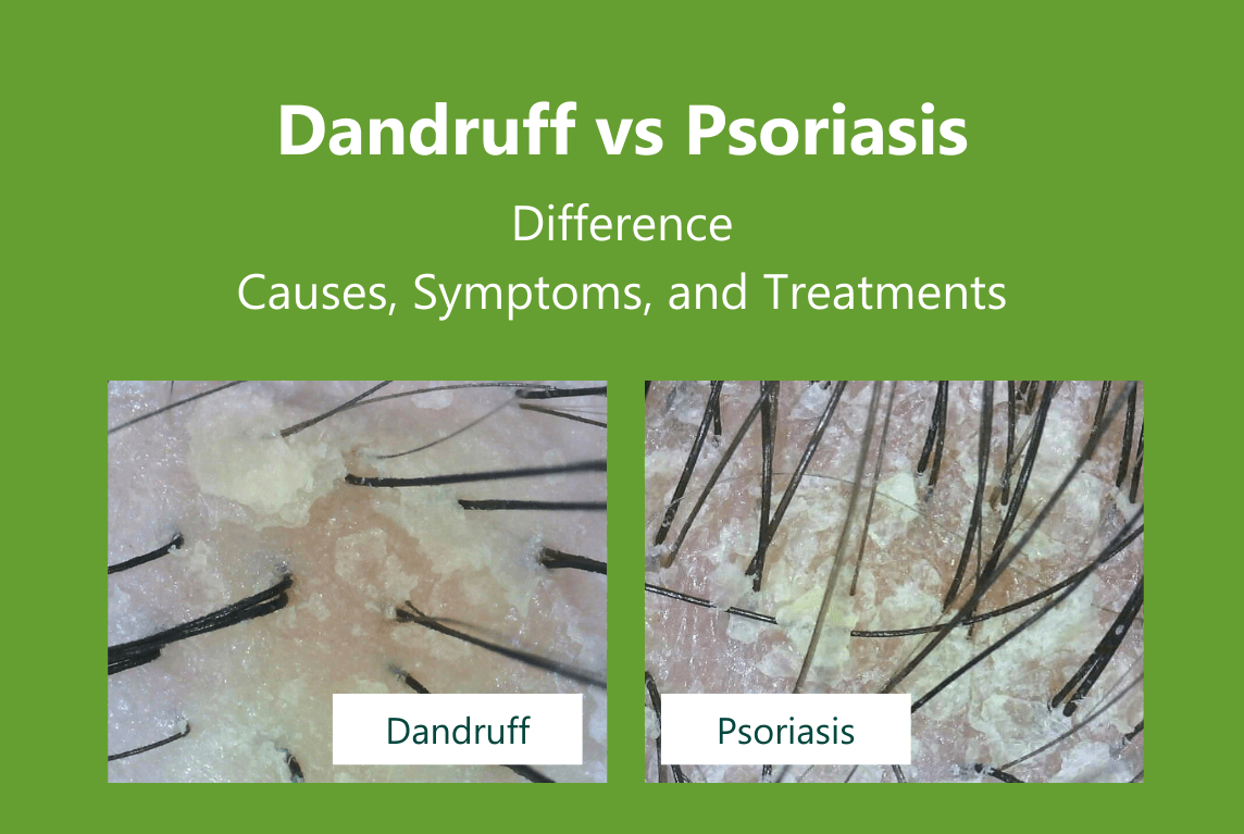 Scalp Psoriasis vs hair Dandruff: Differences, Pictures, Symptoms & Herbal Treatments AROMASE