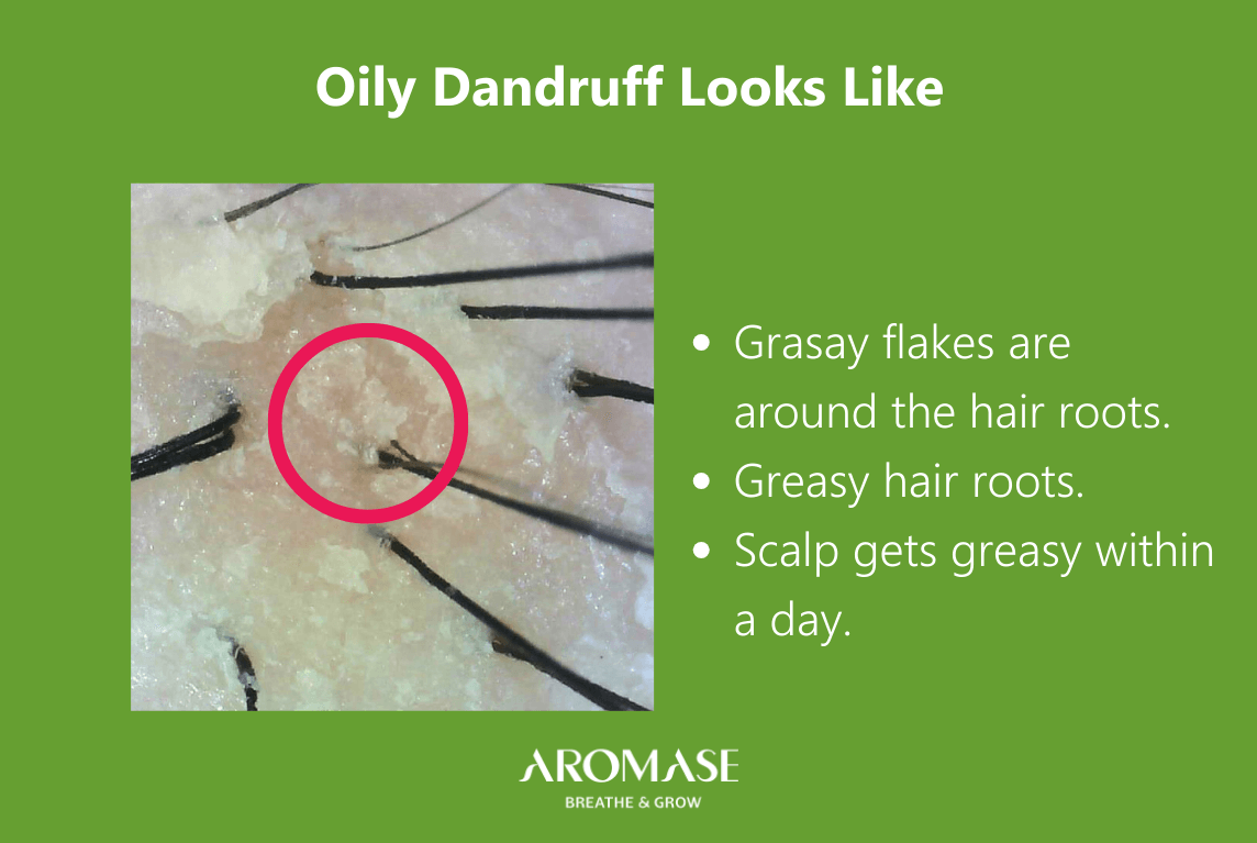 AROMASE_scalp care_The diffrence between Oily Hair and Oily Dandruff (3) oily dandruff look like