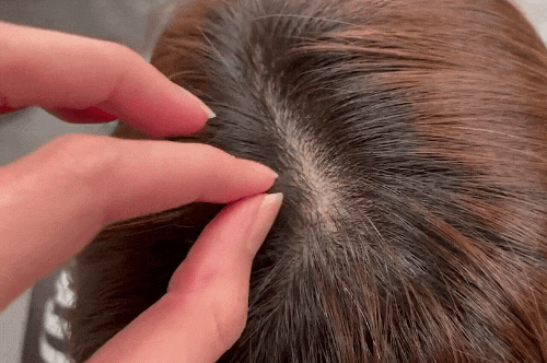 AROMASE-At home check-Alopecia Areata-gif