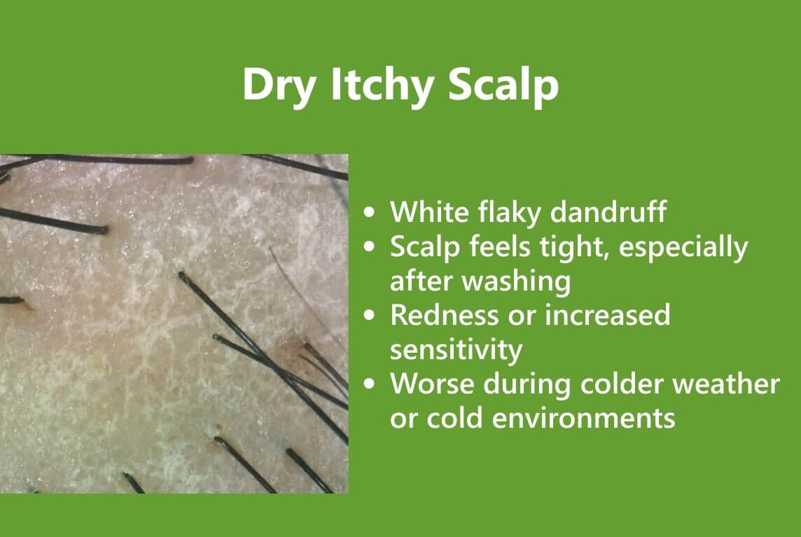 Dry Itchy Scalp Key Differences, Causes, Symptoms, and Treatments AROMASE scalp care