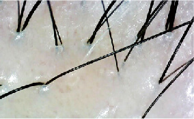 AROMASE-Medipro-dermatitis-result-07