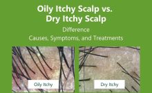 Oily Itchy Scalp vs Dry Itchy Scalp Key Differences, Causes, Symptoms, and Treatments AROMASE scalp care