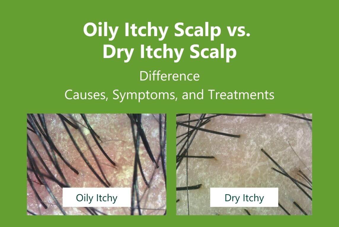 Oily Itchy Scalp vs Dry Itchy Scalp Key Differences, Causes, Symptoms, and Treatments AROMASE scalp care