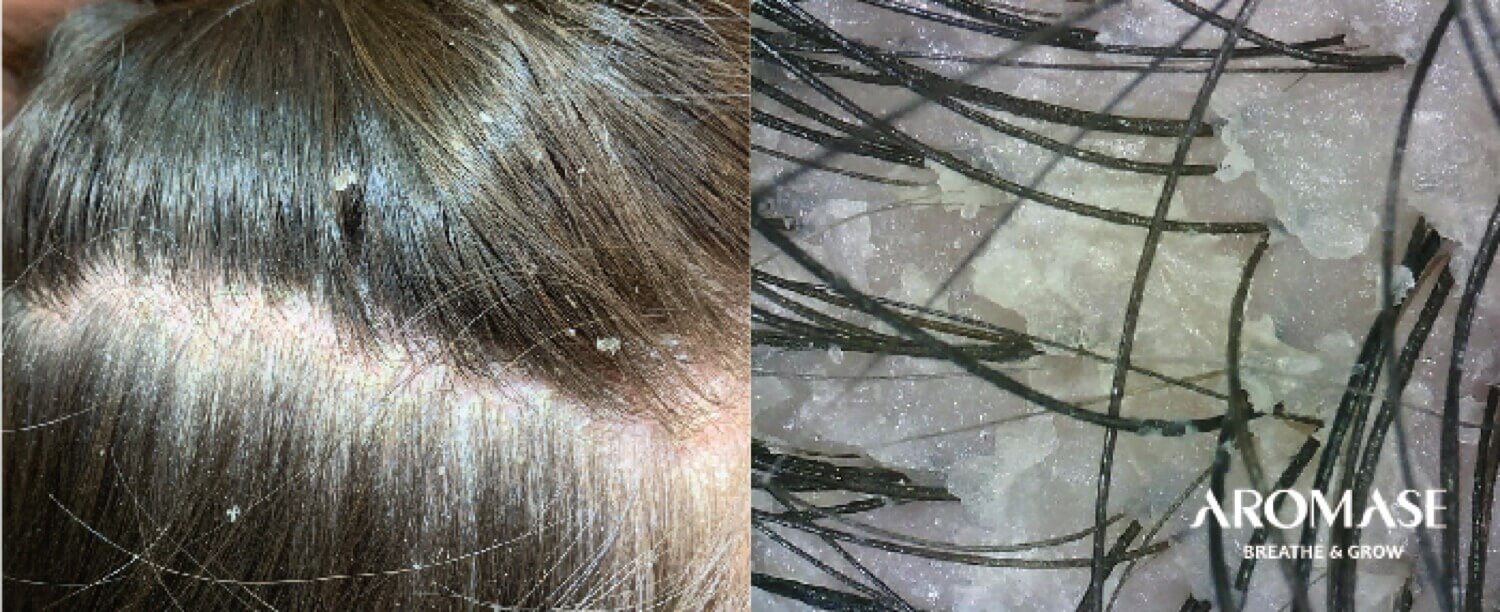 Oily Dandruff-what causes dandruff-AROMASE-scalp care shampoo