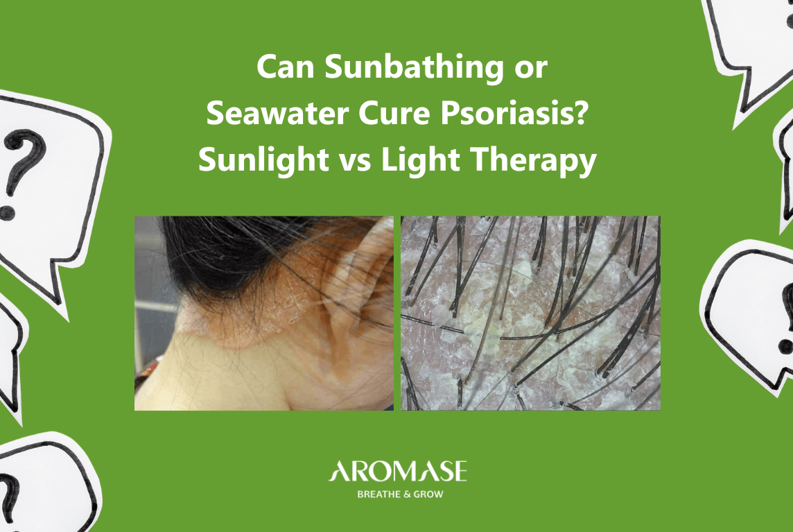 Scalp Psoriasis Is Sunbathing or Saltwater Safe Is Sunlight Better than Light Therapy