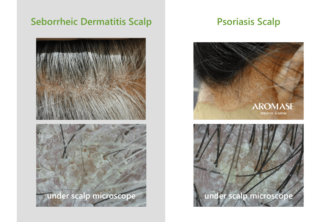 Psoriasis vs Seborrheic Dermatitis What's the Difference_under microscope_AROMSE