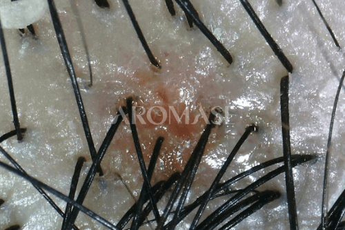 Scalp Folliculitis-scalp pimple-AROMASE (1)