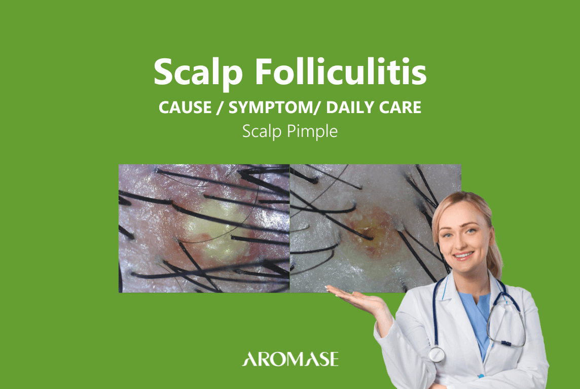 Scalp Folliculitis-scalp pimple-AROMASE (6)