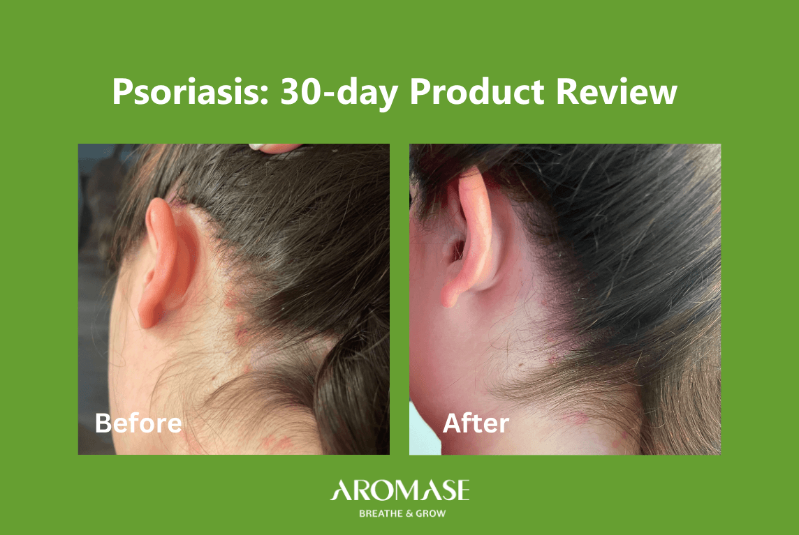 Scalp psoriasis treatment 30days review AROMASE1