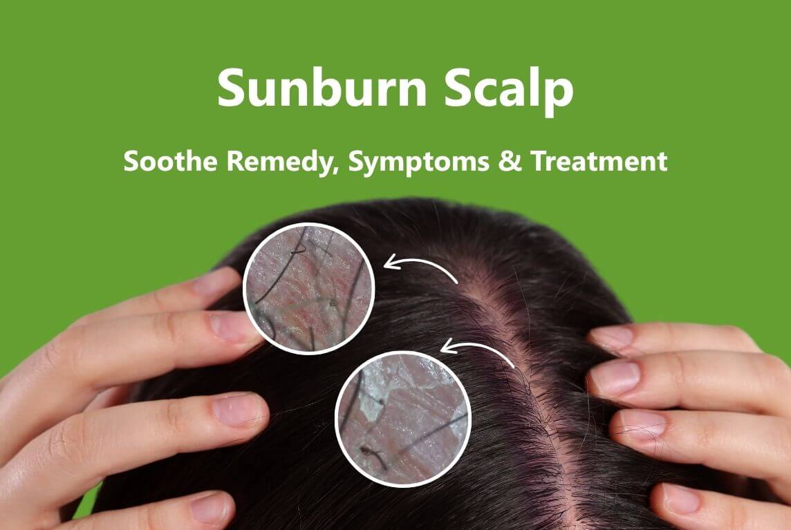 Sunburned Scalp Symptoms, Treatments, and Soothing Remedies AROMASE (1)