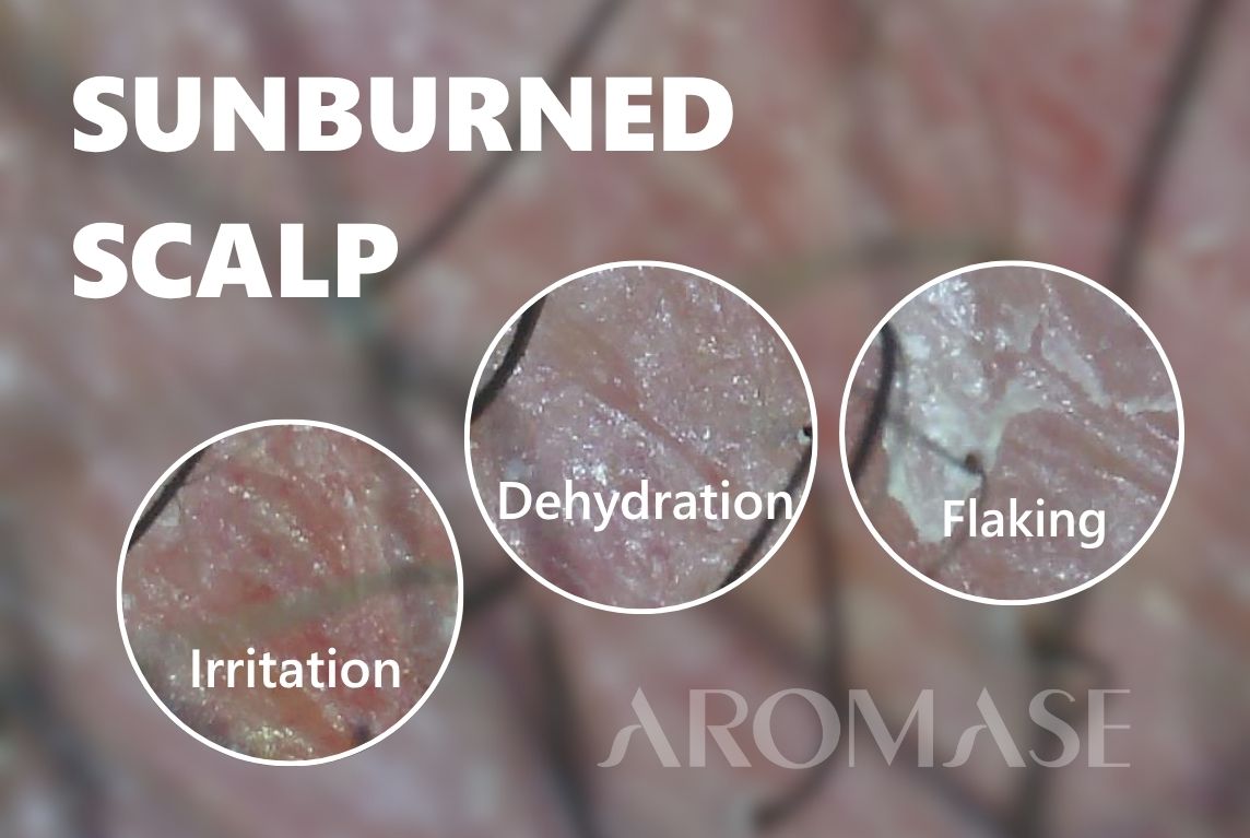 Sunburned Scalp microscope image AROMASE
