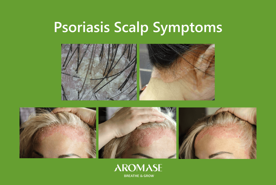 What is the appearance of psoriasis on the scalp