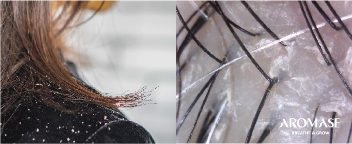 dry dandurff-what causes dandruff-AROMASE-scalp care shampoo