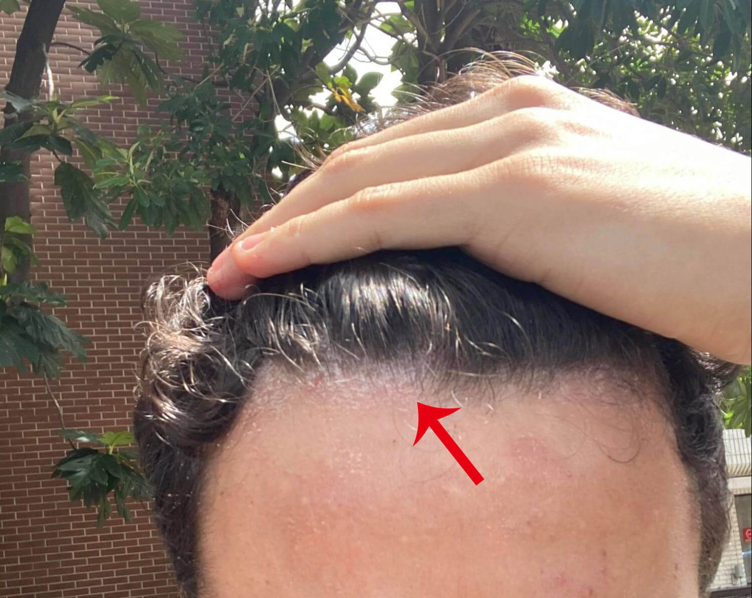 Front head-scalp Psoriasis-aromase scalp case study (1)