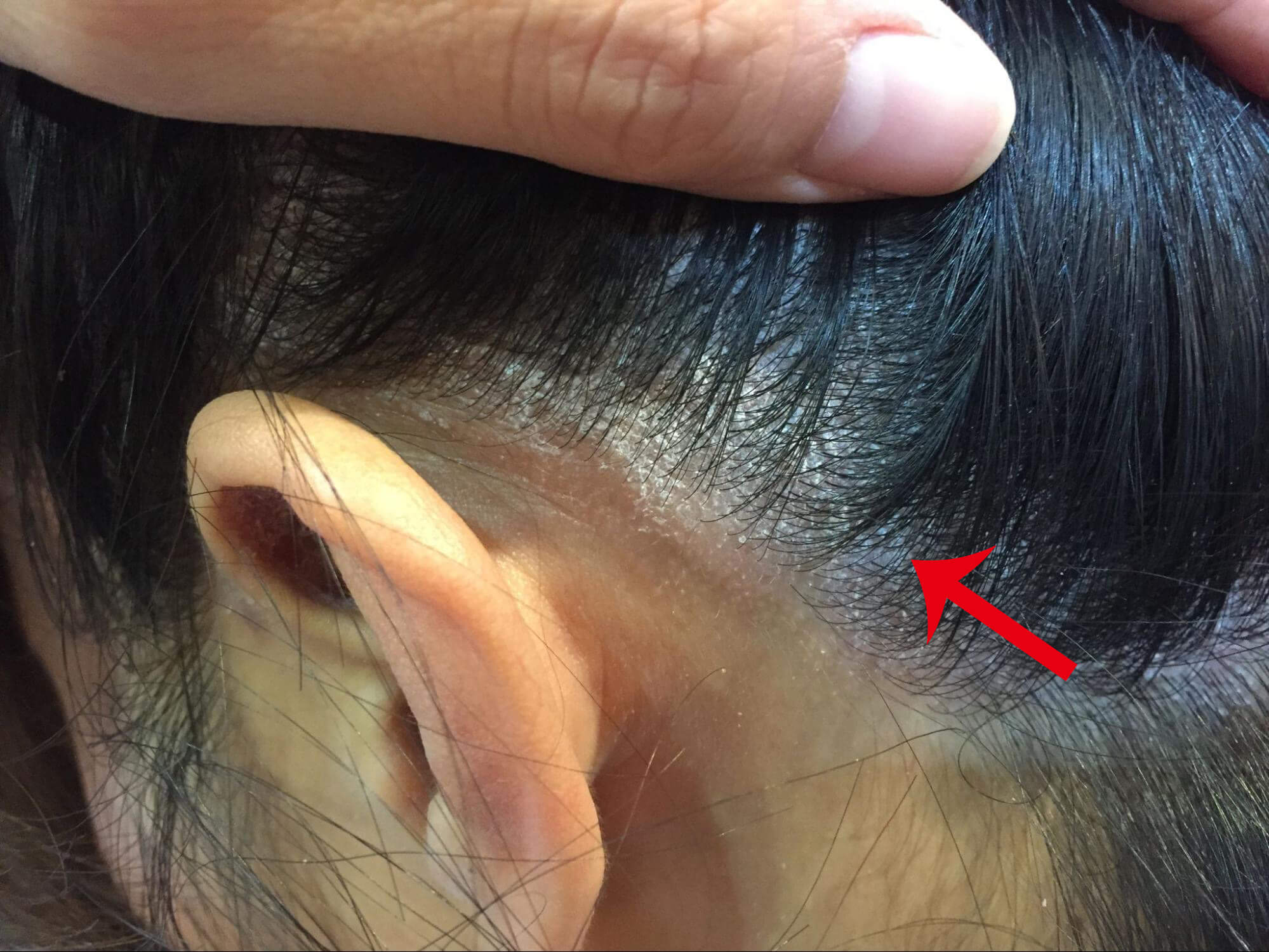 Ear around-scalp Psoriasis-aromase scalp case study (2)