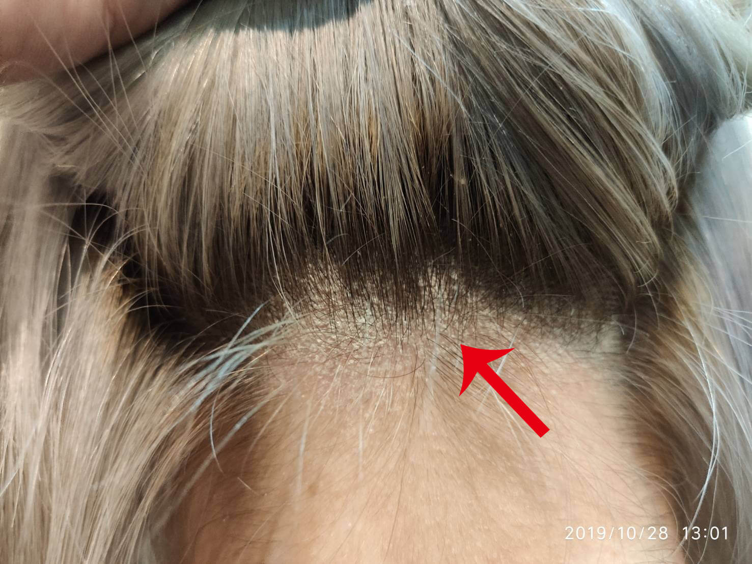 Neck Back-scalp Psoriasis-aromase scalp case study (3)
