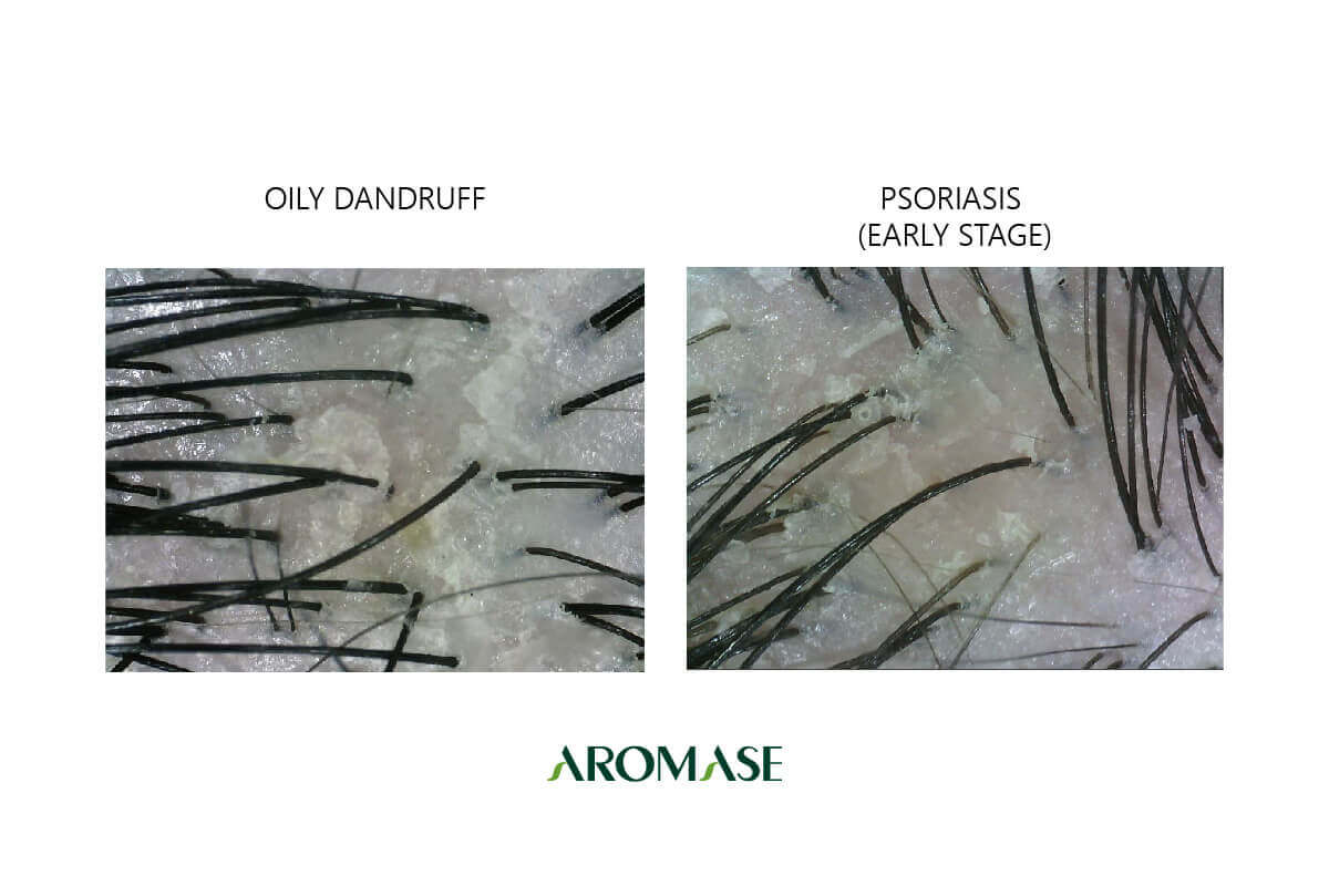the difference of Dandruff psoriasis-aromase scalp case-01-01