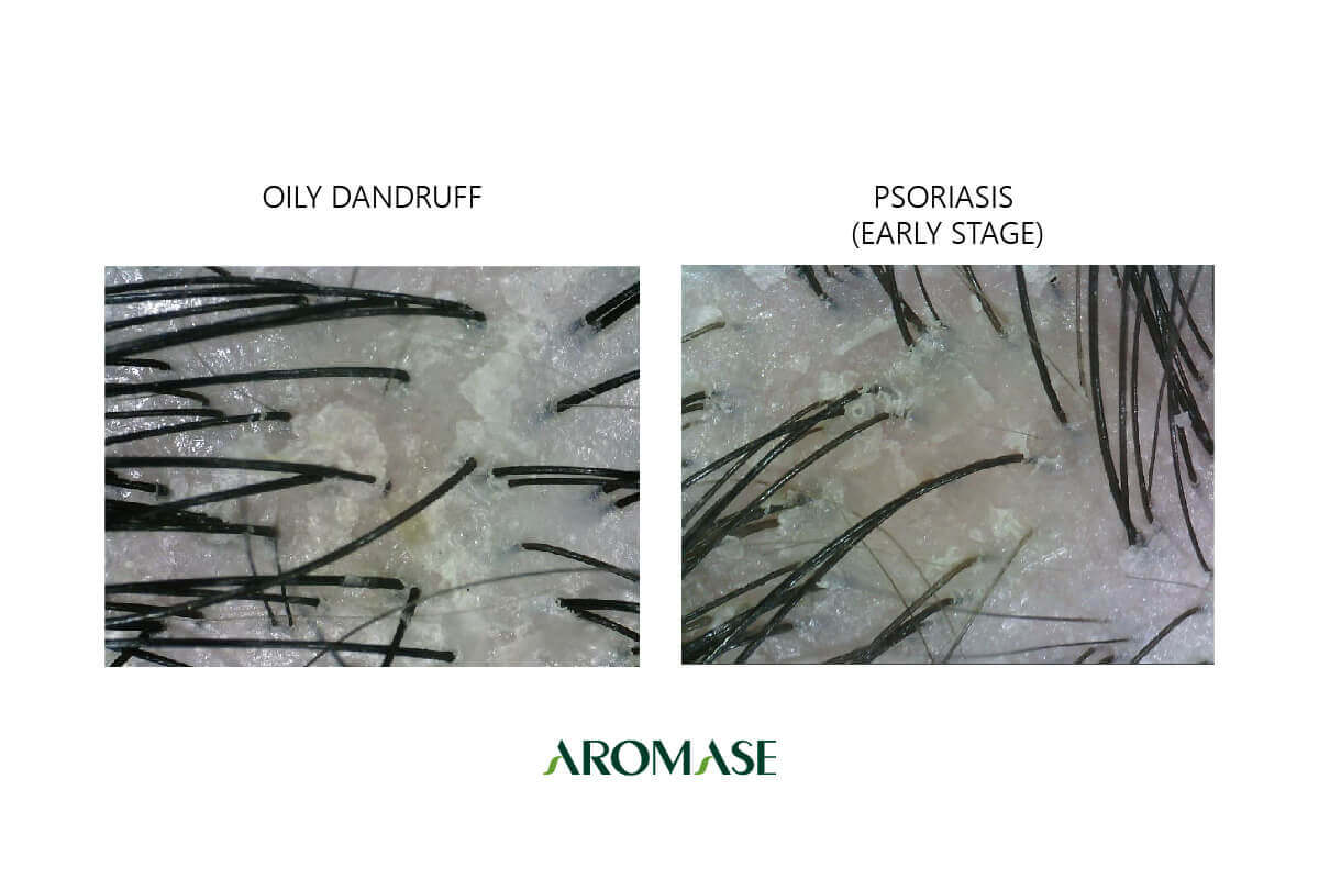 Scalp Psoriasis vs Dandruff: Differences, Pictures, Symptoms & Herbal Treatments early stage AROMASE 
