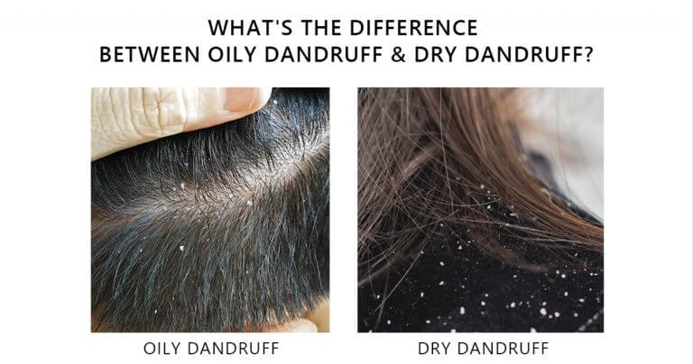 OILY Dandruff vs. DRY Dandruff: Causes, Differences, Symptoms Photos, and Treatments AROMASE scalp care
